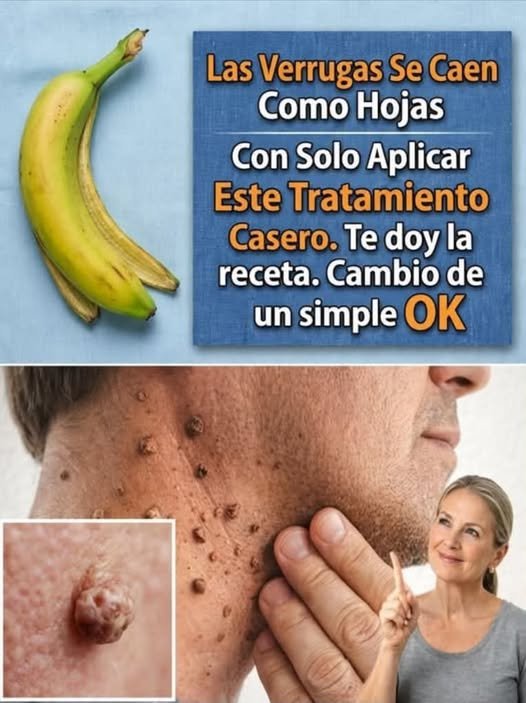 Cáscara de plátano como remedio natural para verrugas