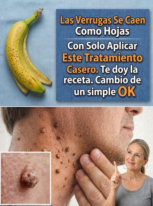 Verrugas en la piel