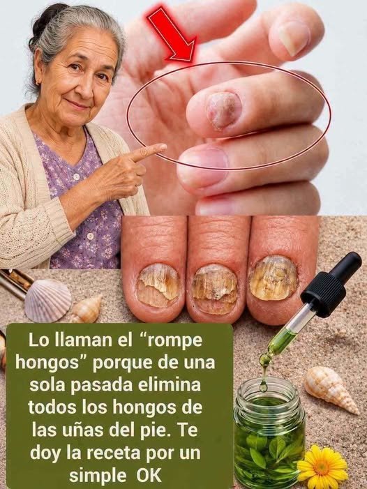 Remedio Rompe Hongos